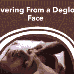 Degloved Face