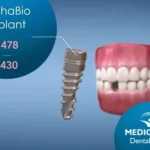Dental Implants in Hungary at Helvetic Clinics