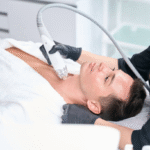 Potenza RF Microneedling